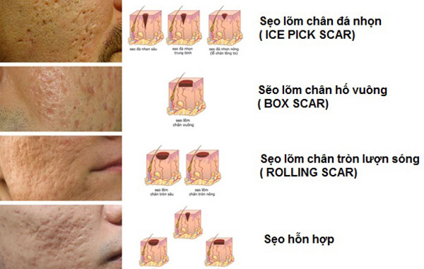 Các loại sẹo