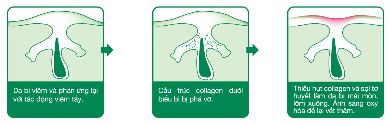 Cơ chế hình thành sẹo